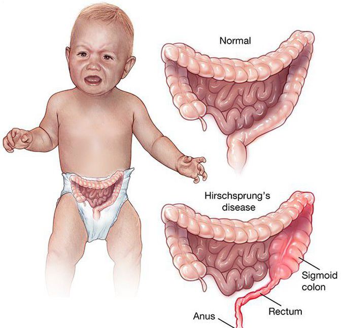 Hirschsprung's disease