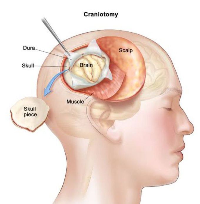 Treatment for Brain lesions