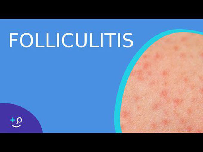 Drugs for Folliculitis