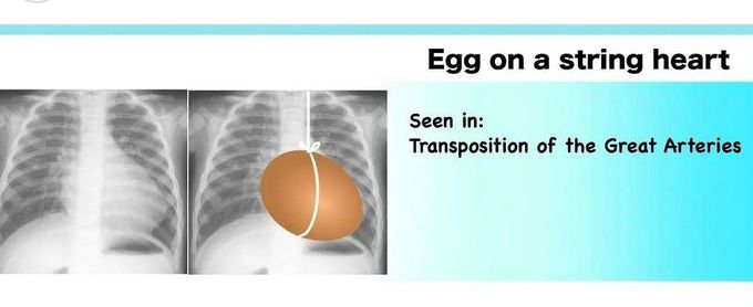 Egg on a String Heart Sign