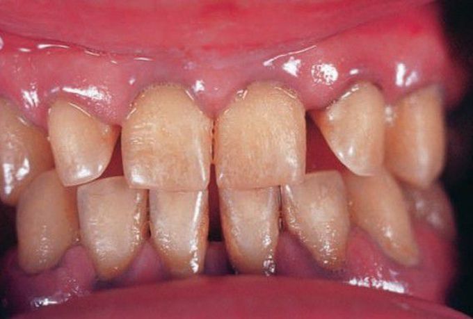 Lead pigmentation of gingival margins