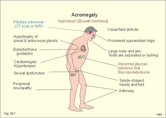 The sings of hyper GH,Acromegaly