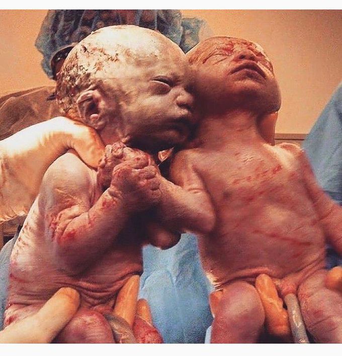 Twins Born Holding hands!