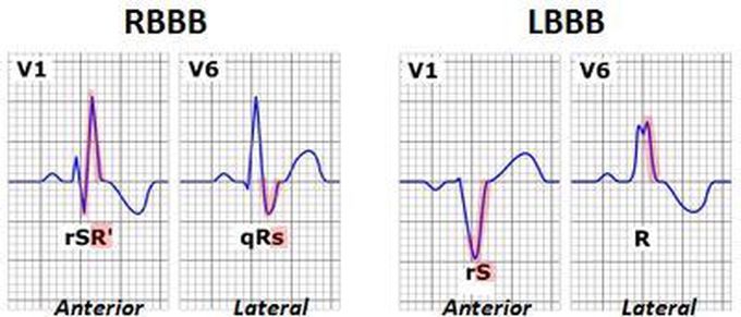 RBBB vs. LBBB on ECG - MEDizzy