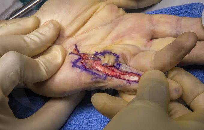 Dupuytren's contracture treatment