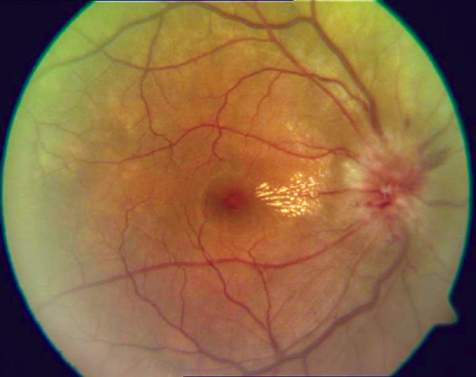 Optic neuritis