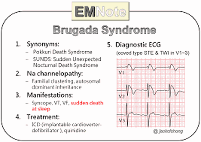 What causes Brugada syndrome?