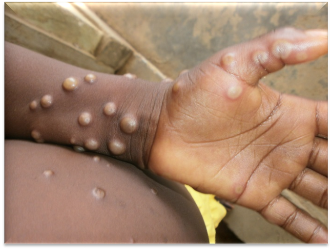 Monkey pox Symptoms