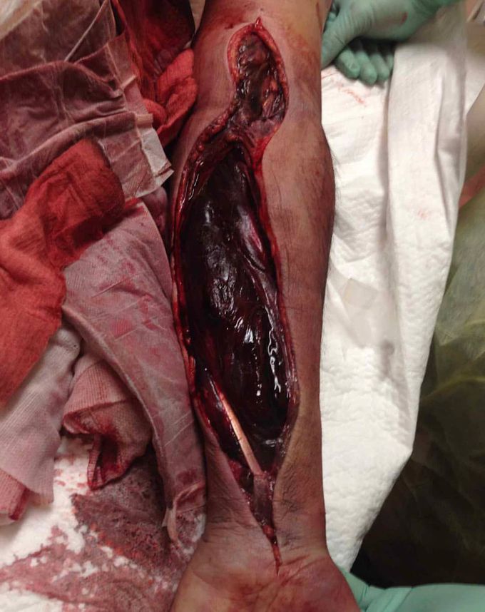 Fasciotomy after severe frostbites!  