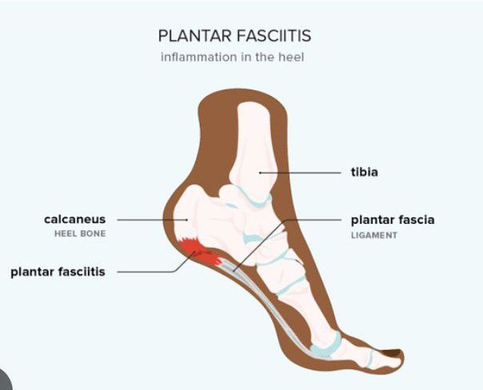 Symptoms of Plantar fasciitis