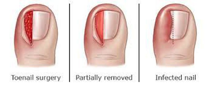 Causes of ingrown nails