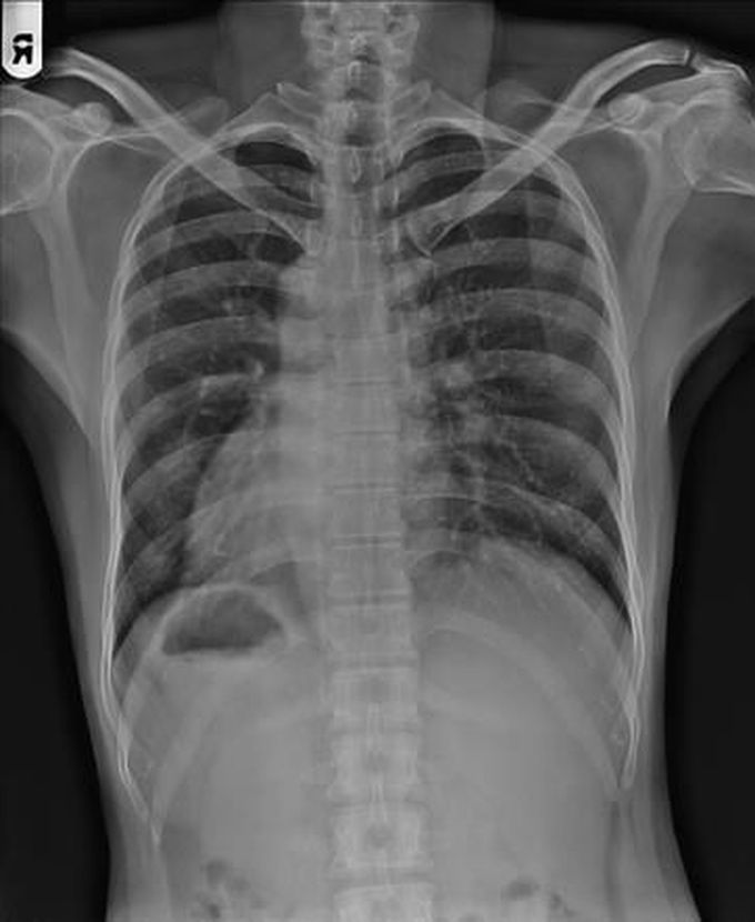 Situs Inversus: Mirror Image of Viscera