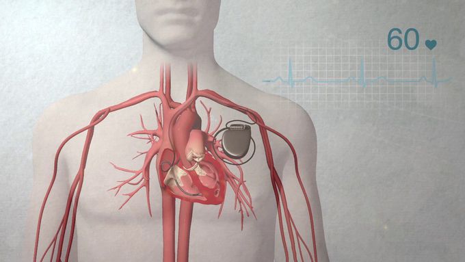 What is a pacemaker??