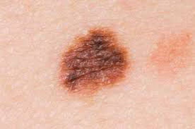 Signs of melanoma