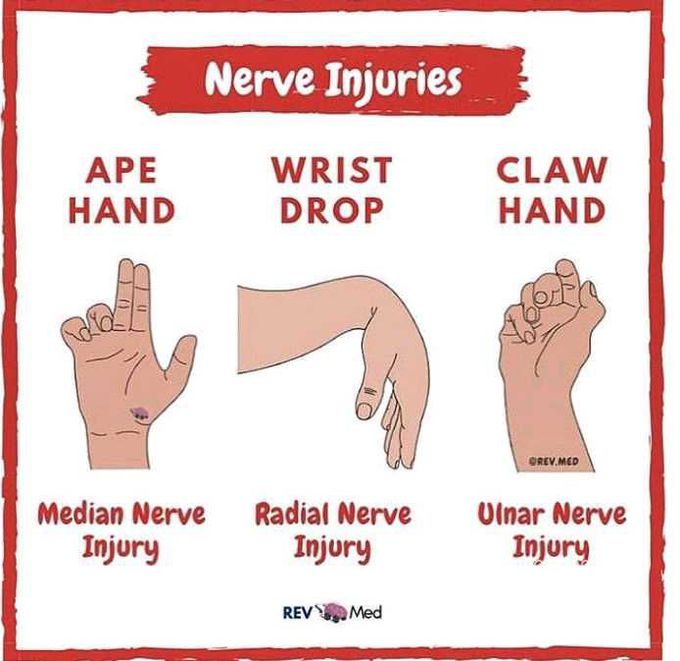 Nerves injury