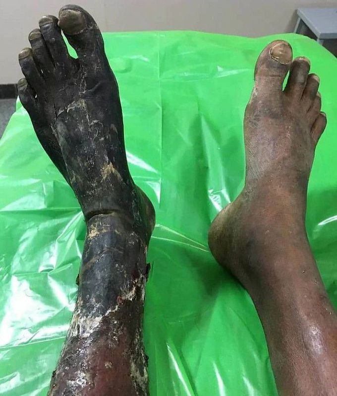 Dry gangrene