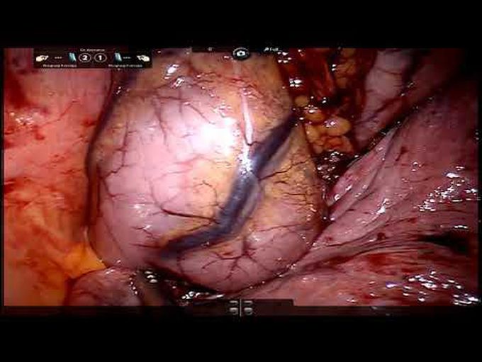 Quick Tips and Tricks for Robot-Assisted Esophagectomy: Ivor Lewis and McKeown