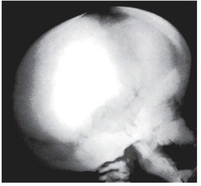 Osteopetrosis
