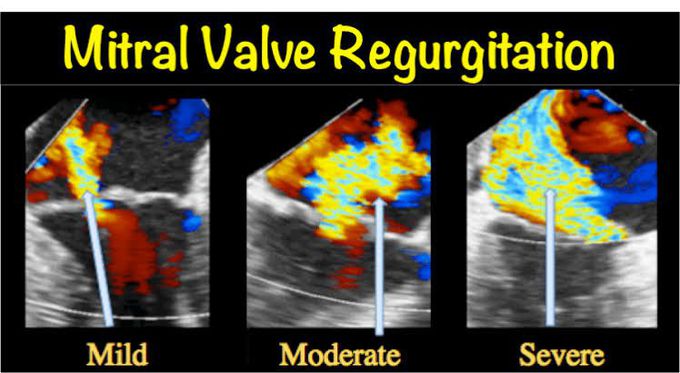 Mitral valve regurgitation causes