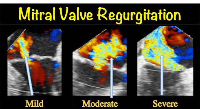 Mitral valve regurgitation causes