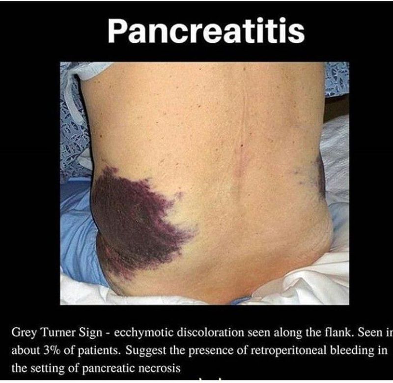 Grey Turner's Sign, Overview, Causes & Treatment - Video & Lesson  Transcript