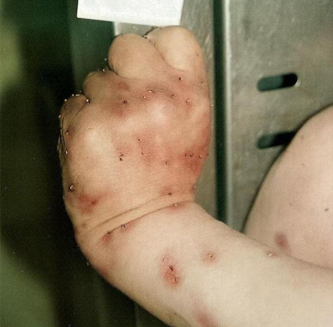 Bee Sting Allergy Led to Death of a 49-year-old.