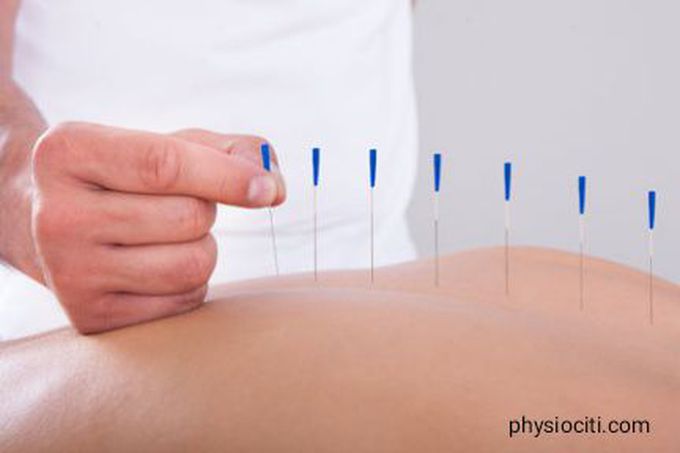 Dry Needling vs Acupuncture: Learn The Difference! - physiociti