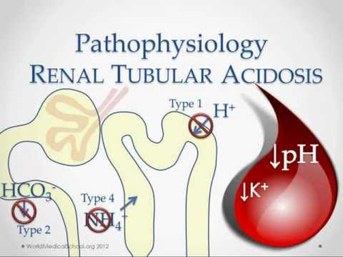 Kidney Diseases IX-
Renal Tubular Acidosis II