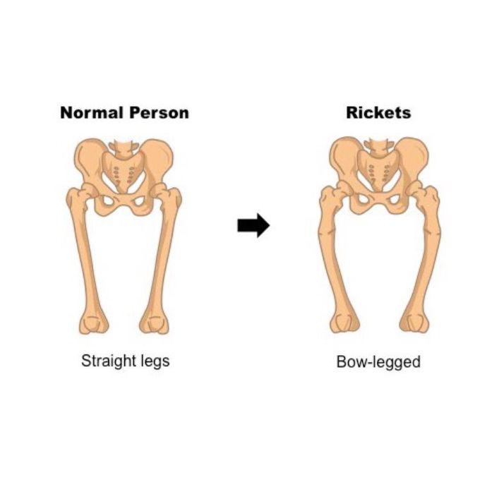 Rickets