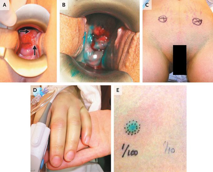 Anaphylaxis Associated with Blue Dye