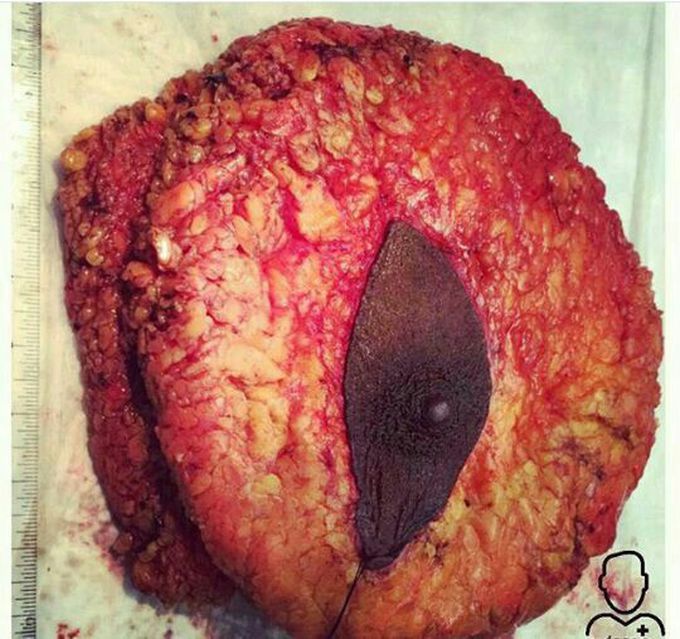 Breast cancer