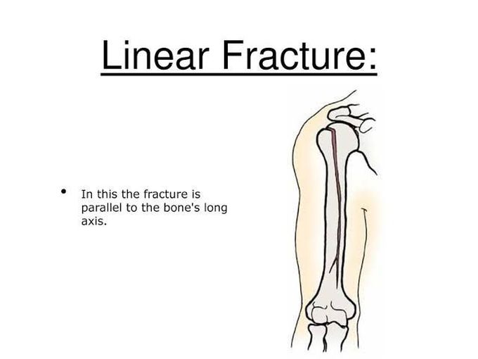 linear bone fracture