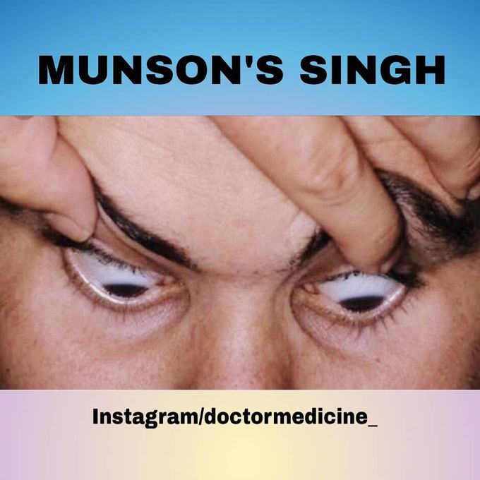 Munson's sign