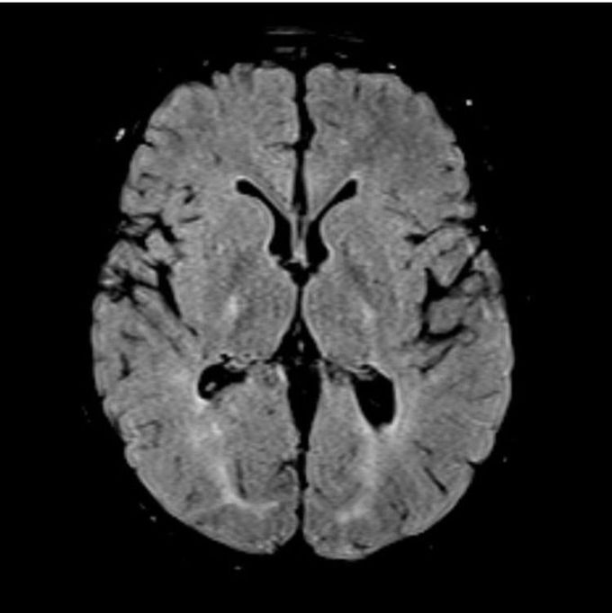 18q syndrome is a rare chromosomal anomaly where there is a deletion of part of the long arm of chromosome 18. Associated symptoms and findings vary widely, as does their severity. Characteristic features include short stature, mental retardation and hypotonia, facial and distal skeletal abnormalities.  Chromosome 18q syndrome appears to result from a spontaneous, sporadic chromosomal error during very early embryonic development.