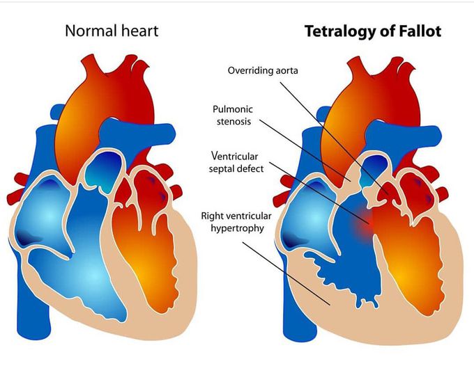 Tetralogy of fall at is a combination  of  four  congenital  abnormalities .
