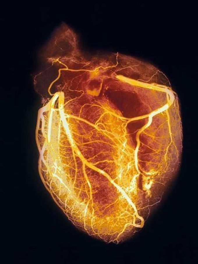 Angiogram of the heart 