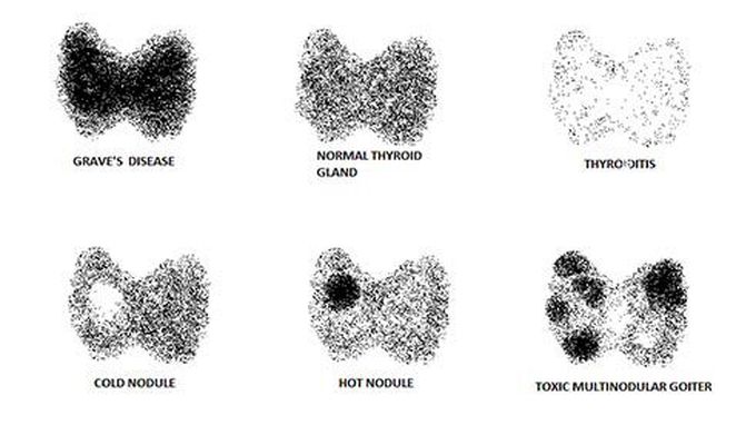 Radioactive Iodine Uptake Test