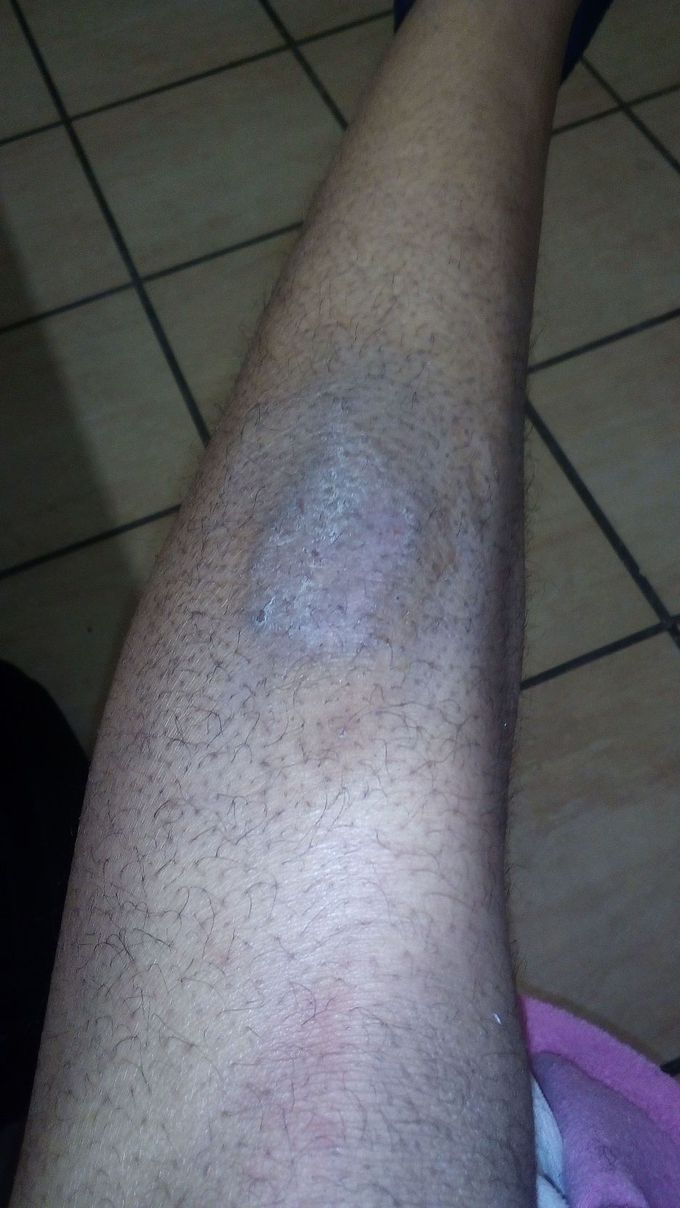 Skin disease