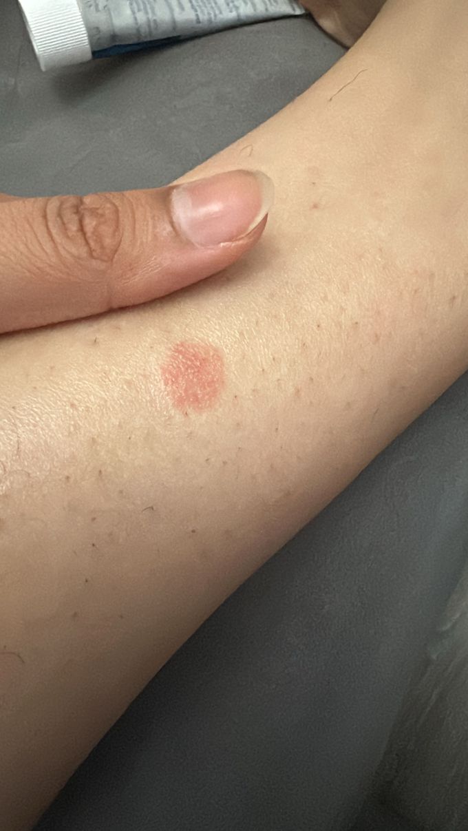 Hi! I have these spots on my legs. These are itchy . Can anyone tell what are these?