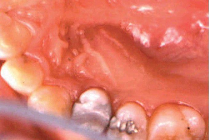 Palatal space infection