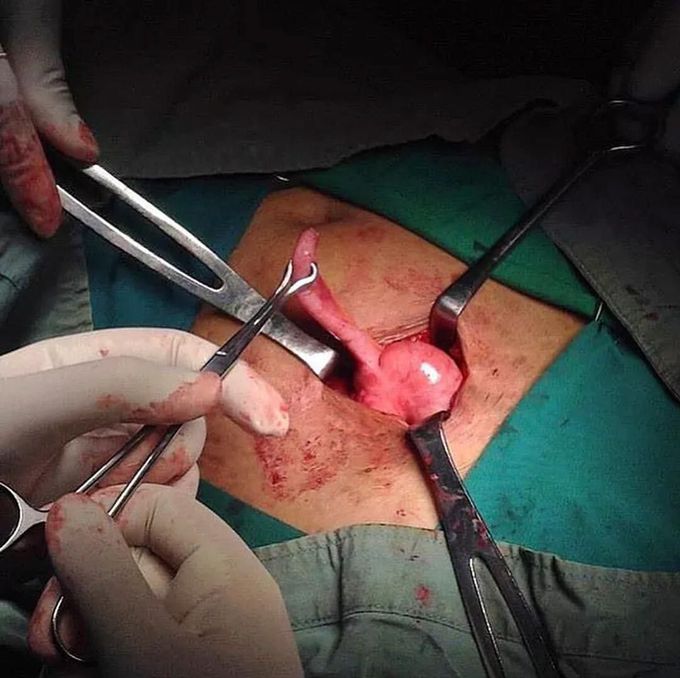 Groundbreaking - appendectomy unneeded during acute appendicitis!! 