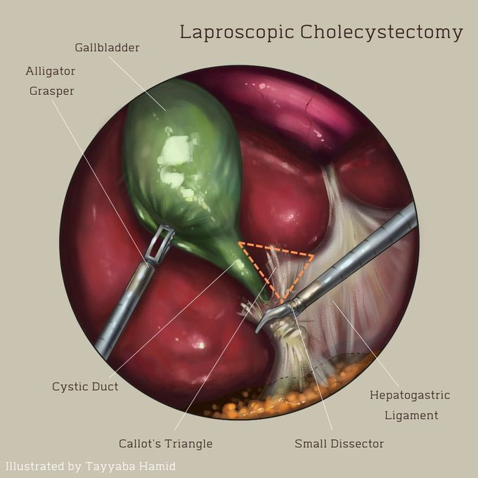 Laproscopic Cholecystectomy illustrated by me
