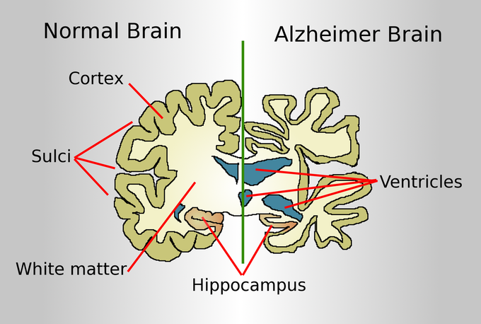 Treatment of alzheimer's disease