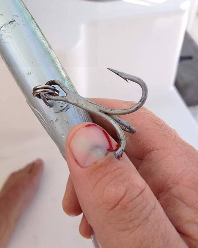 ⚠️ Fishhook injury!  