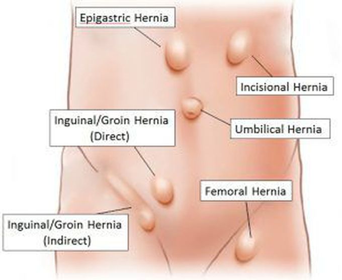 Types of hernia.