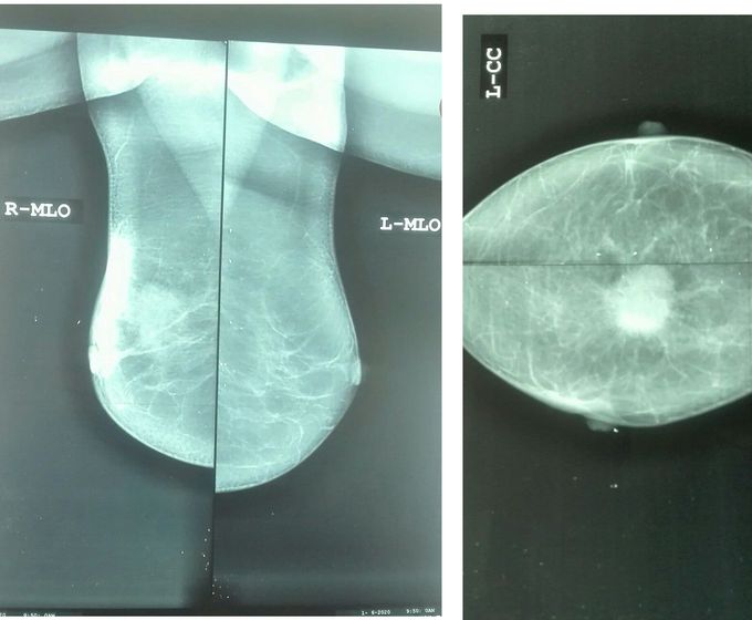 Mammogram