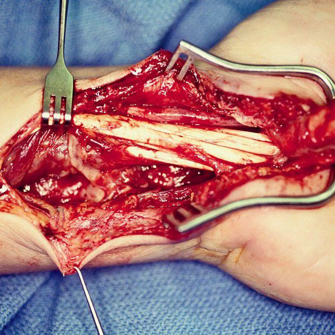 Deep infection following open carpal tunnel release