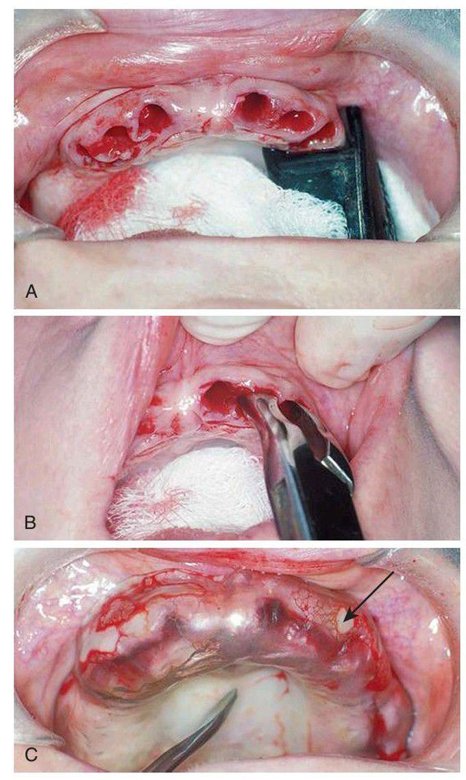 Immediate denture surgery