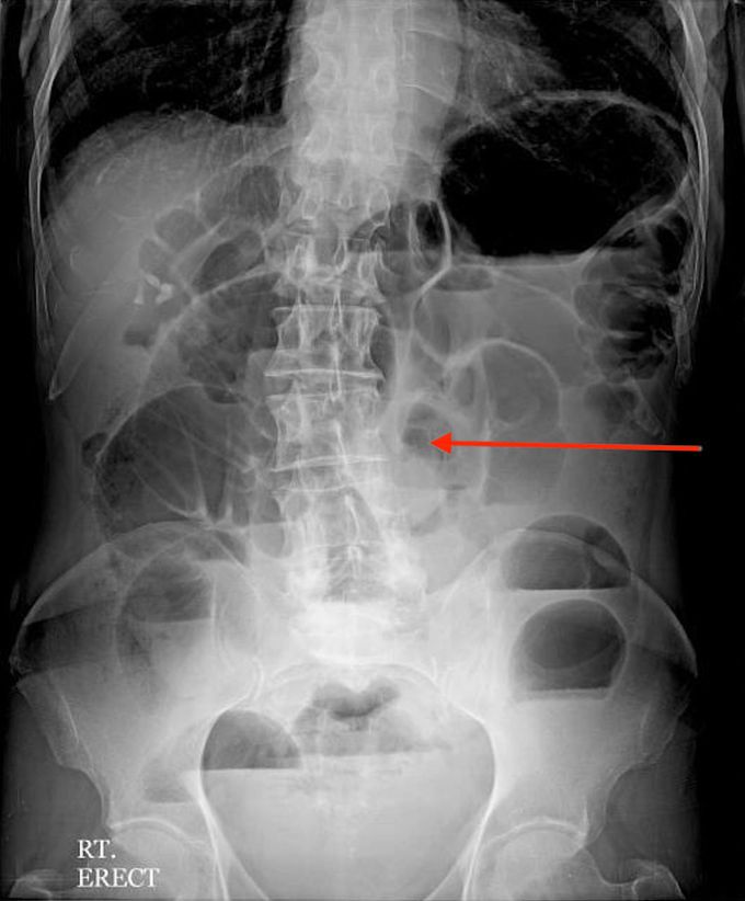 AXR: Small bowel obstruction