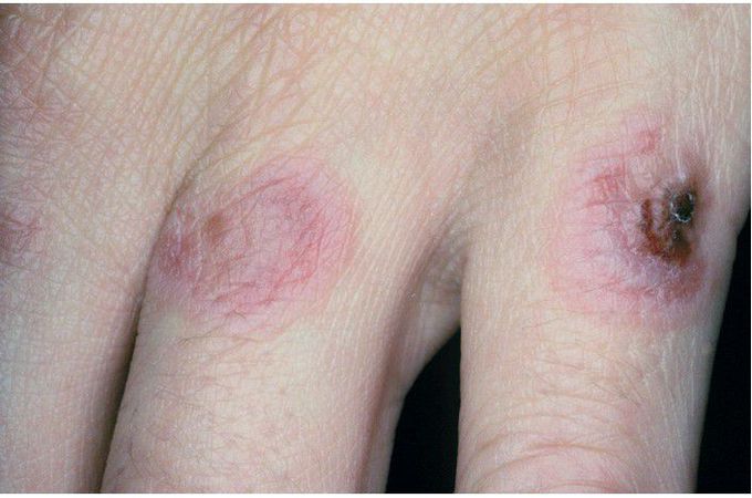 Erythema Multiforme